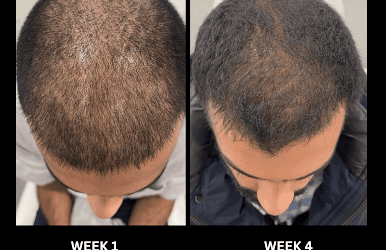 Understanding PRP Treatment for Hair Loss